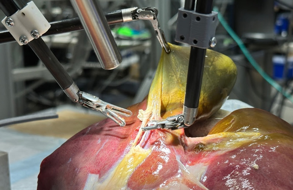 Johns Hopkins teaches robot to perform a gallbladder removal on a realistic patient