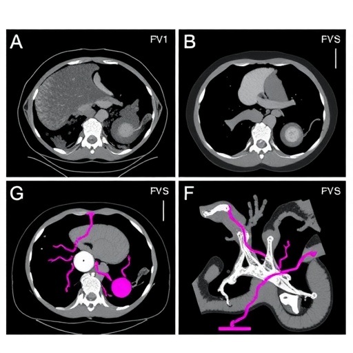 Imaging and Surgery of Retroperitoneal Vascular Leiomyosarcoma